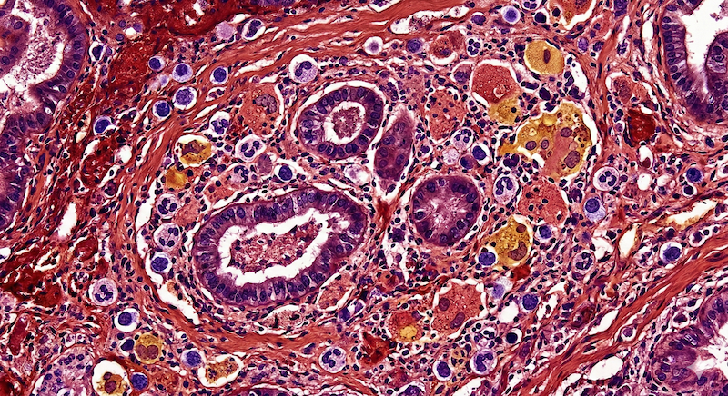 Endometriosis